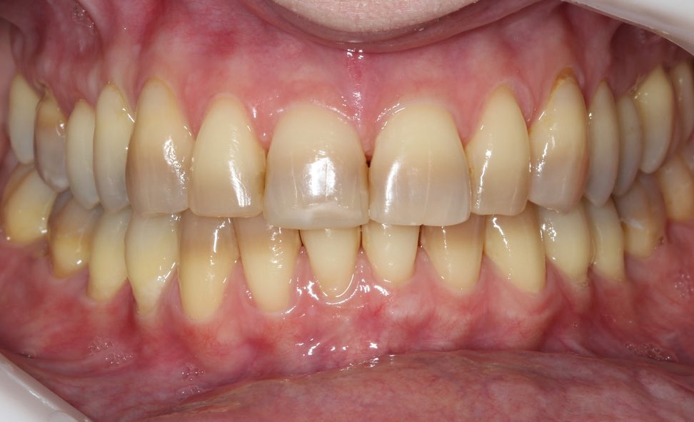 odontologia Agostini antes dentes lente